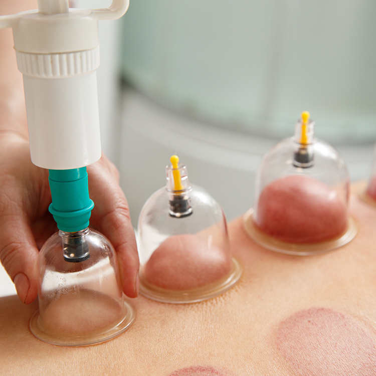 Cupping therapie (Hijama)